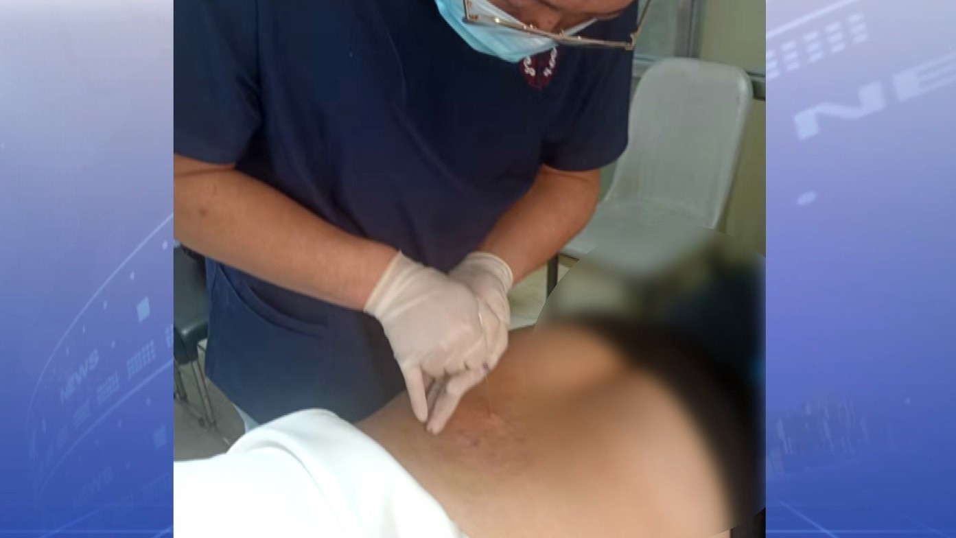 非医师针灸 卫生部门查处 非医师针灸 卫生部门查处