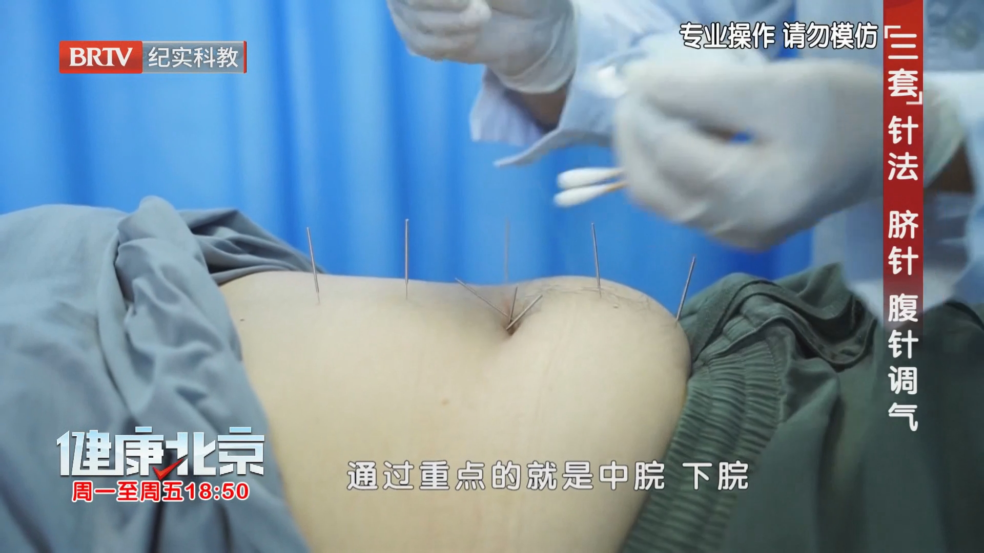 “三套”针法 脐针 腹针调气