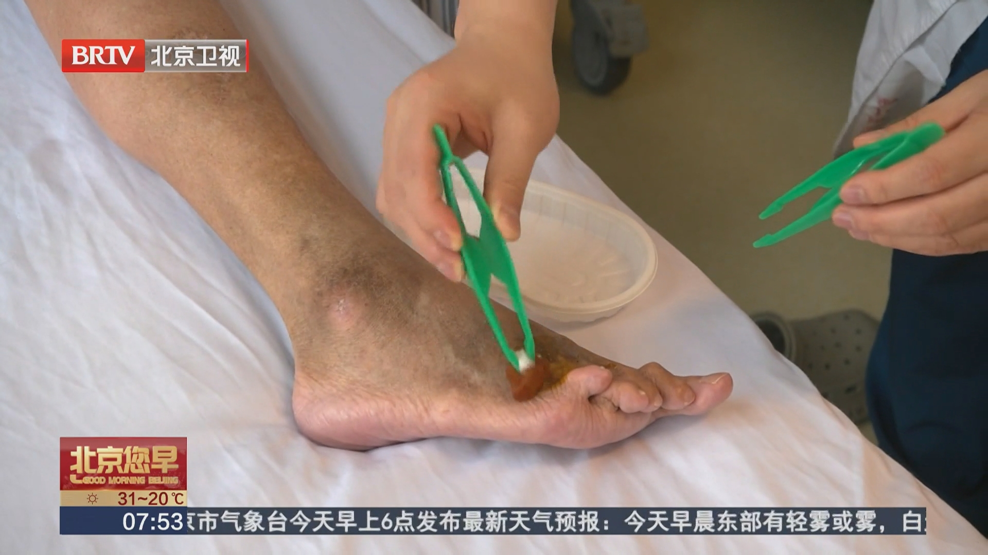 健康早知道 脚上一个小伤口 差点截了整条腿
