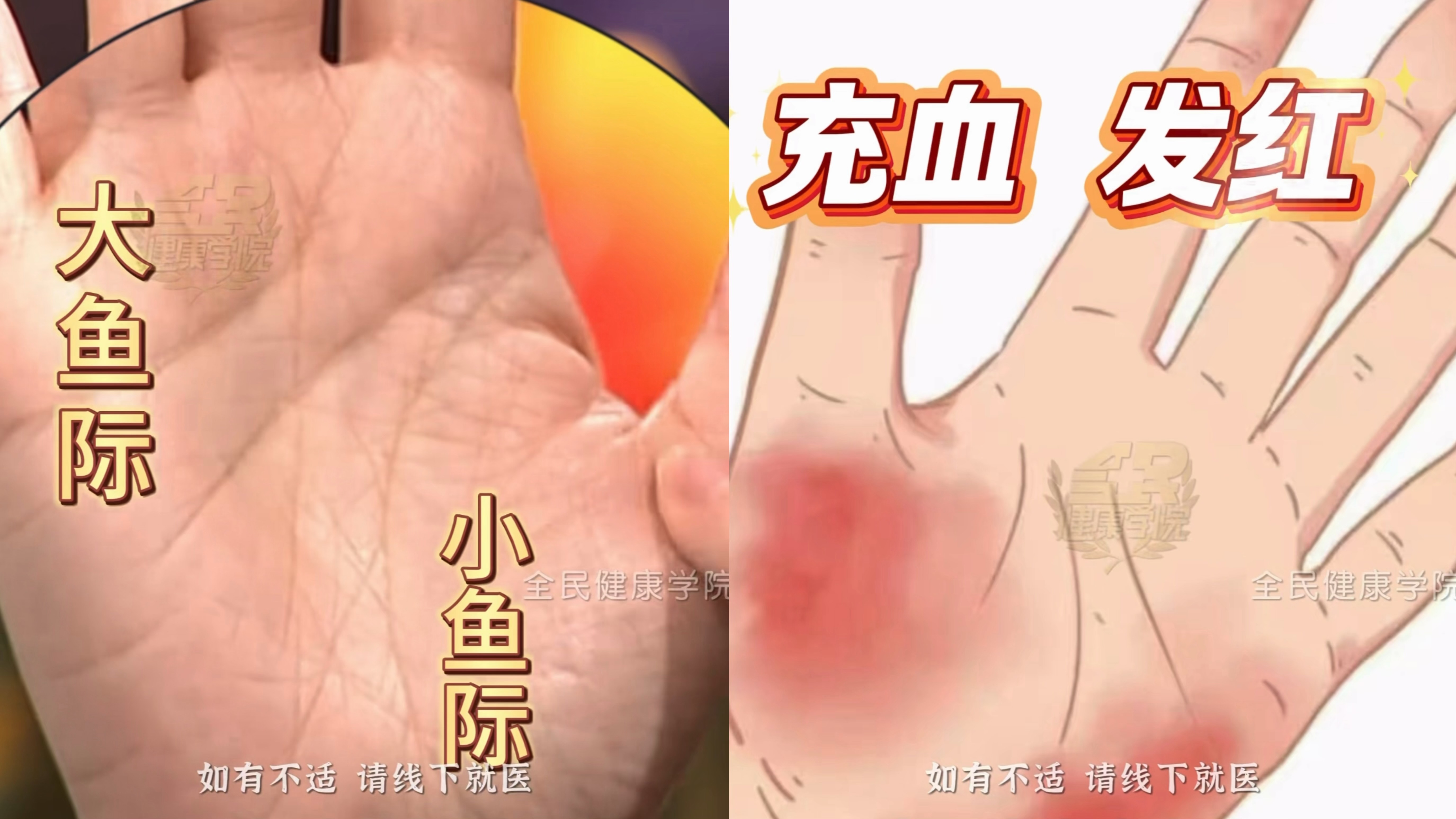 张雪因手掌太红被网友劝就医,医生提醒 张雪因手掌太红被网友劝就医,医生提醒