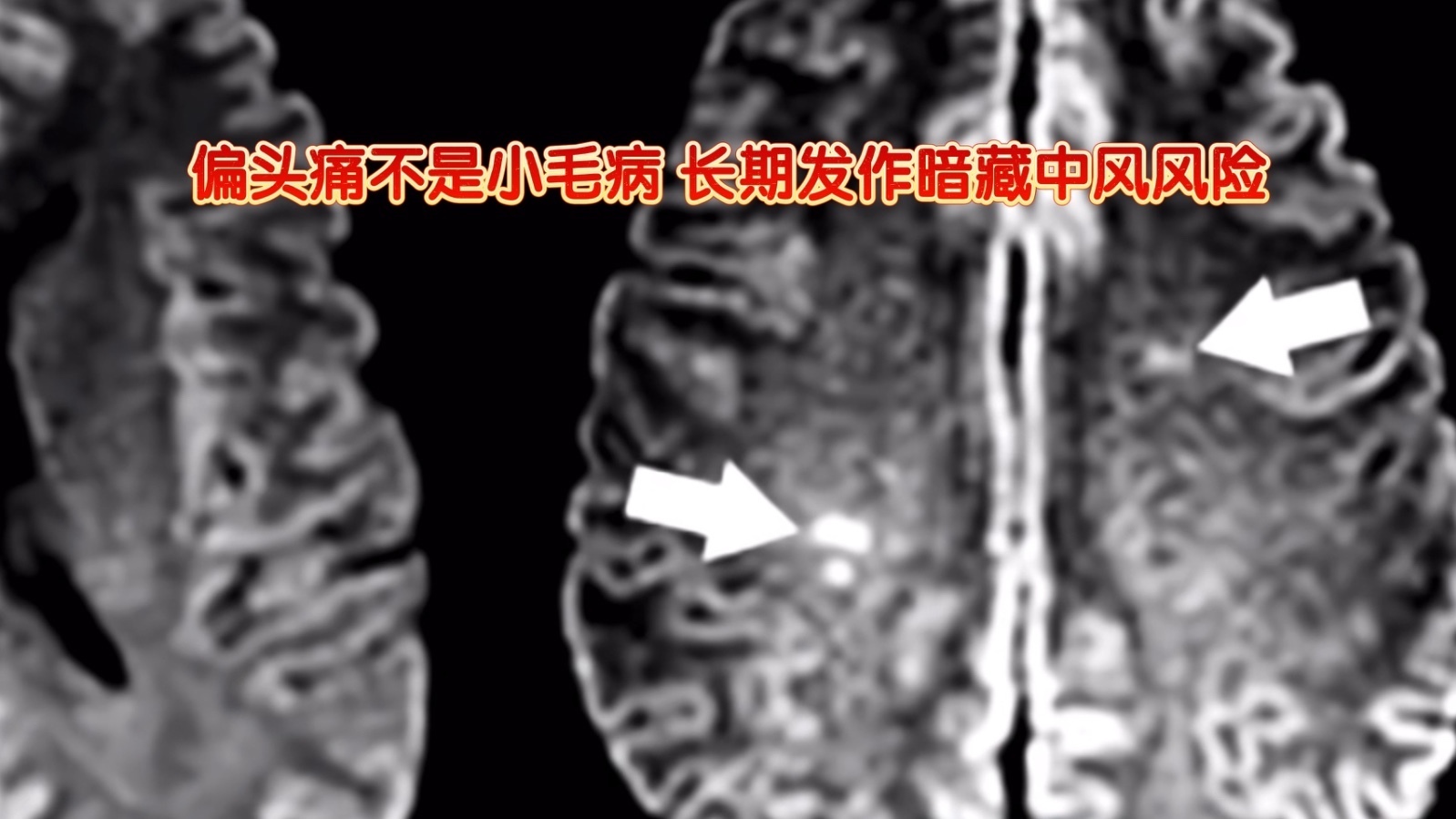 偏头痛不是小毛病,长期发作暗藏中风风险 偏头痛不是小毛病,长期发作暗藏中风风险