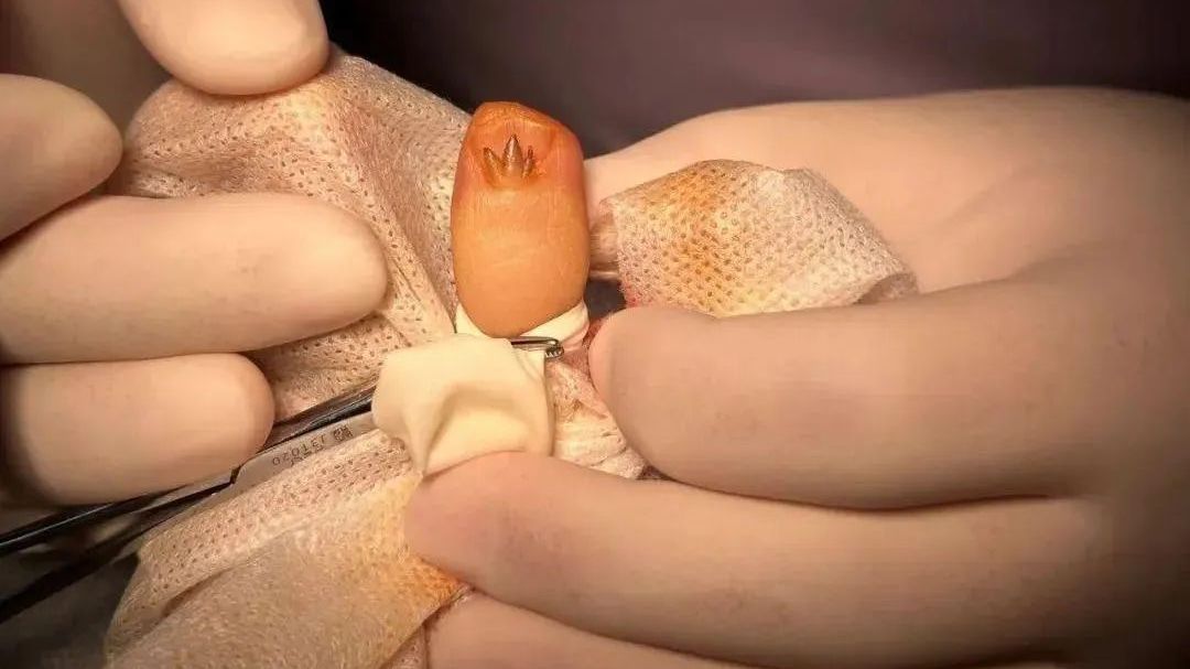 女子指甲惊现“三叉戟”!医生:赶紧切!这件事不能频繁做 女子指甲惊现“三叉戟”!医生:赶紧切!这件事不能频繁做