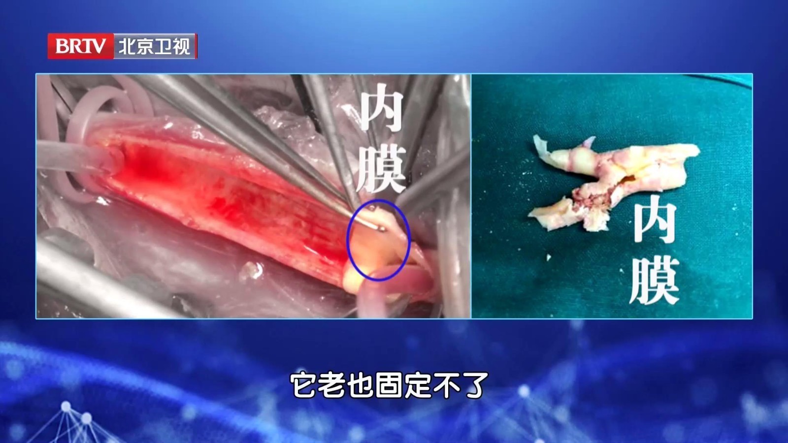 颈动脉超声可以检查颈部血管状态,哪些人群需要做颈动脉超声? 颈动脉超声可以检查颈部血管状态,哪些人群需要做颈动脉超声?