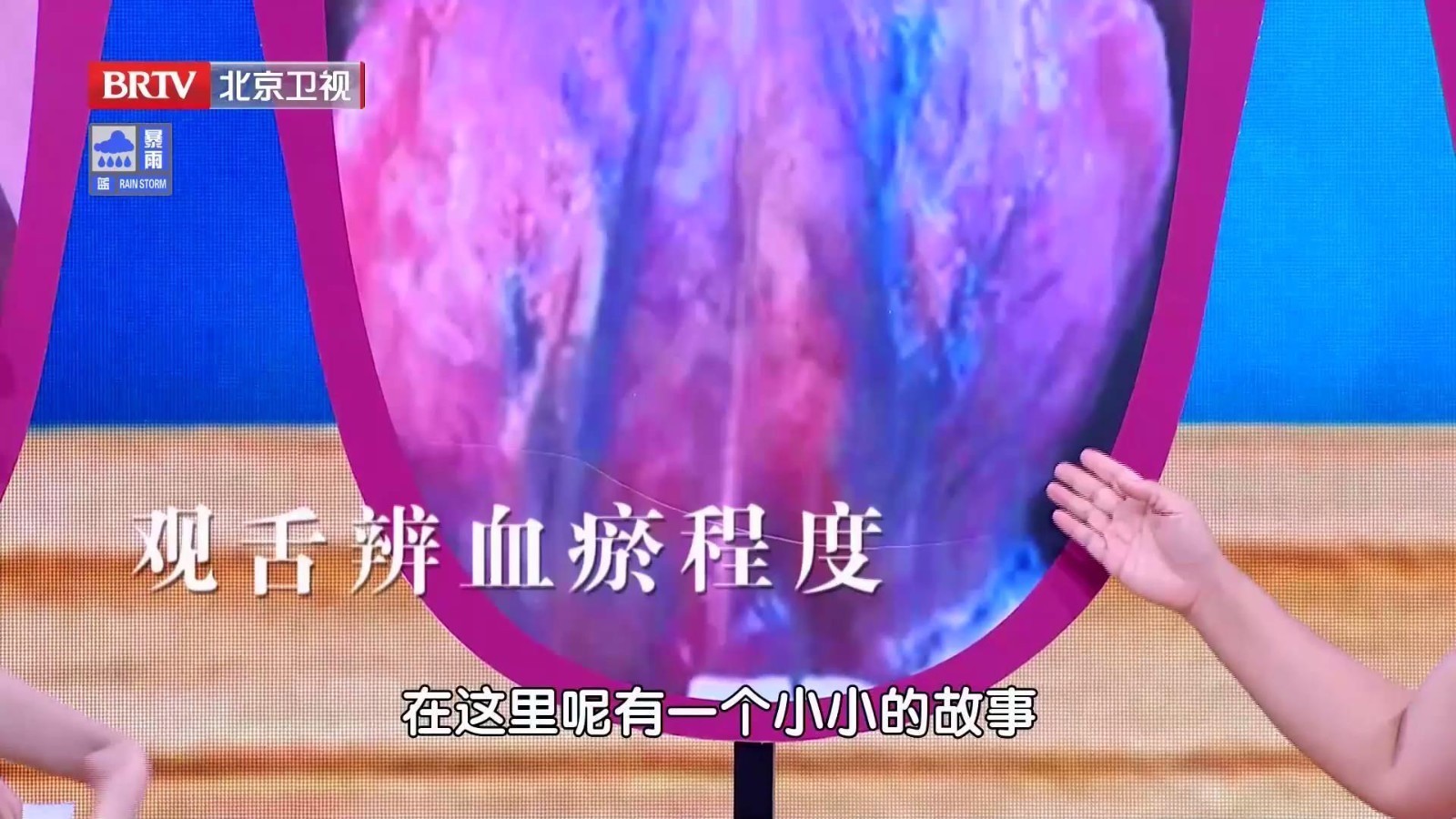 学一学看舌象，从舌底静脉、舌面颜色，辨血瘀程度~