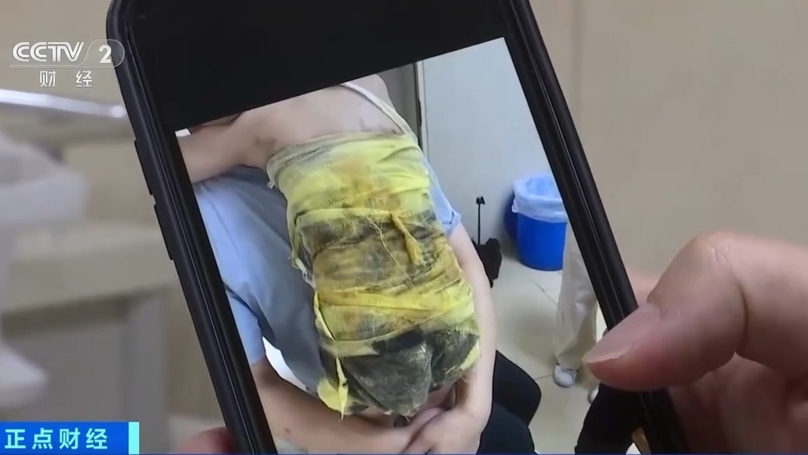 夏季高发儿童烫伤 处理不当或致严重感染