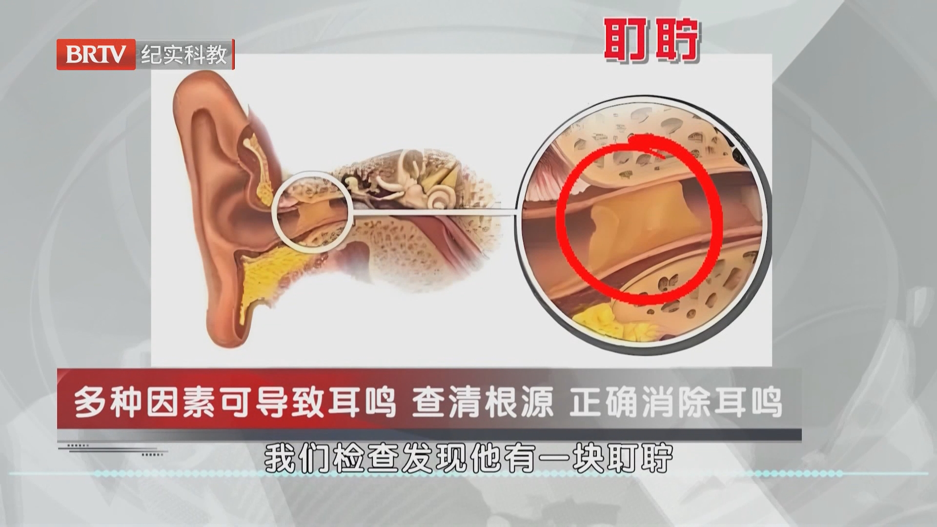 《职场健康说》20261029永不消逝的噪音 耳鸣