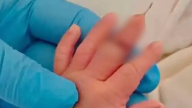 新生儿剪脐带时被剪断手指，涉事医院回应：情况属实，正在处理中；该医院两年内医疗纠纷诉讼达14起
