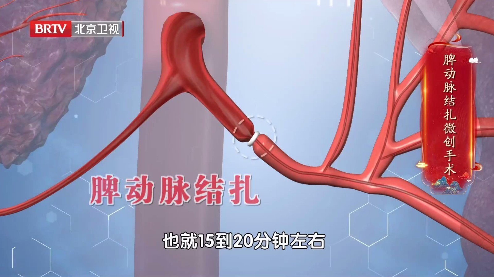 15-20分钟就能完成的手术——脾动脉结扎，适合哪些人？_北京时间