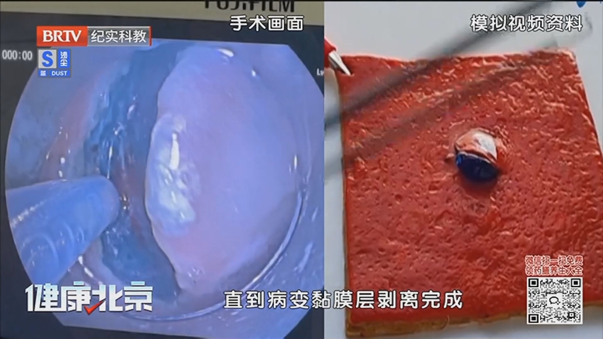 《健康北京》20250311免开刀的“超级微创”