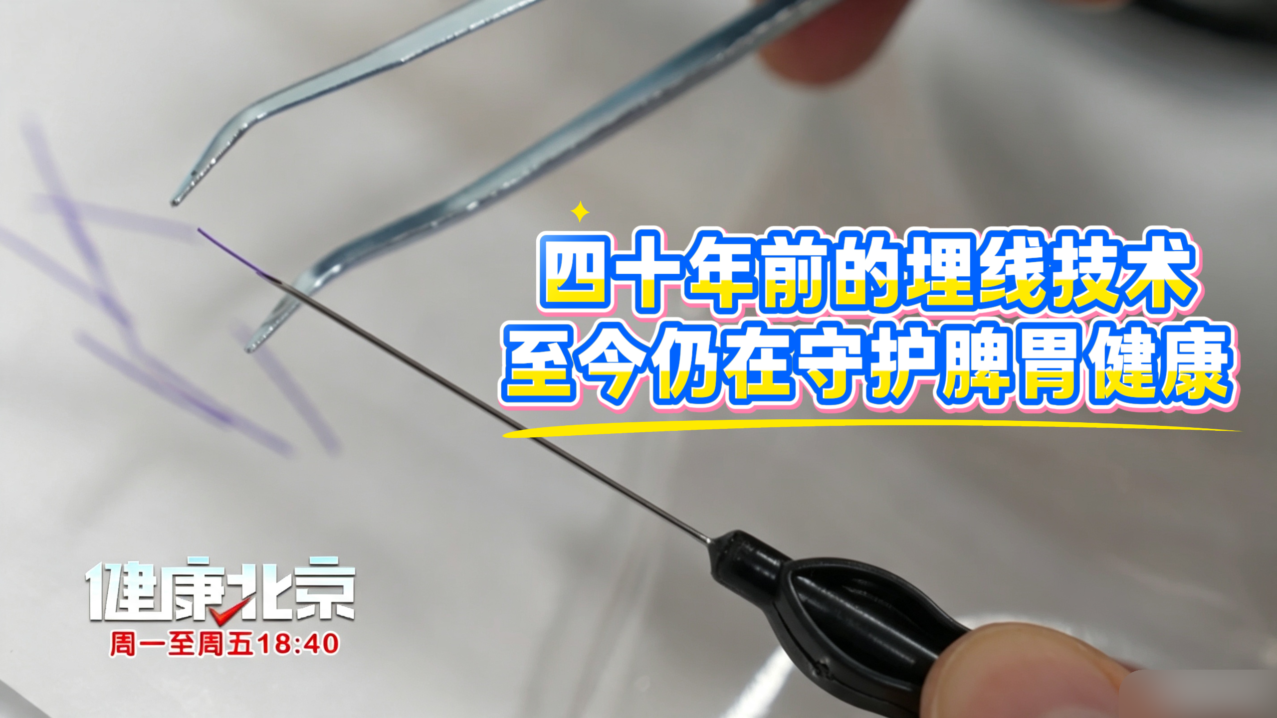 四十年前的埋线技术，至今仍在守护脾胃健康