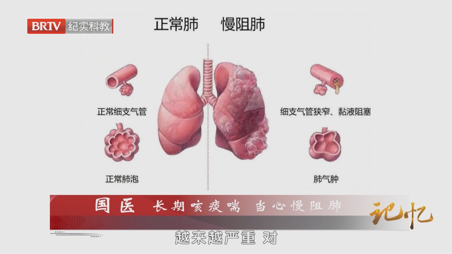 《记忆》20261009国医 长期咳痰喘 当心慢阻肺