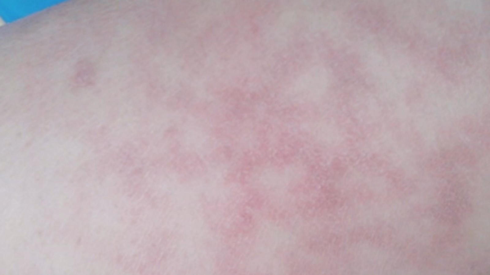 冬季取暖 小心火激红斑