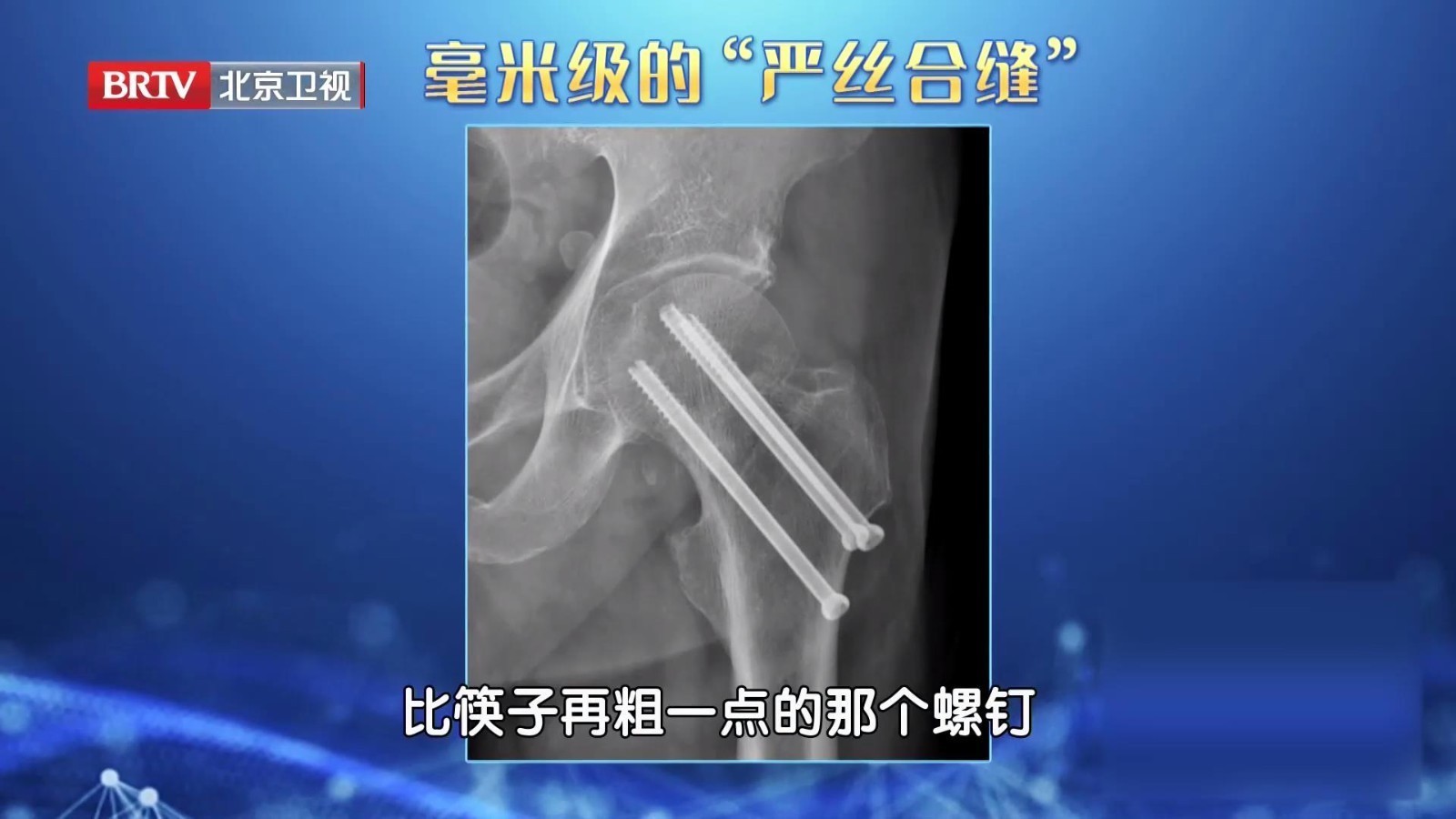 通过微创手术，用螺钉将骨折的股骨颈“严丝合缝”的拼接上