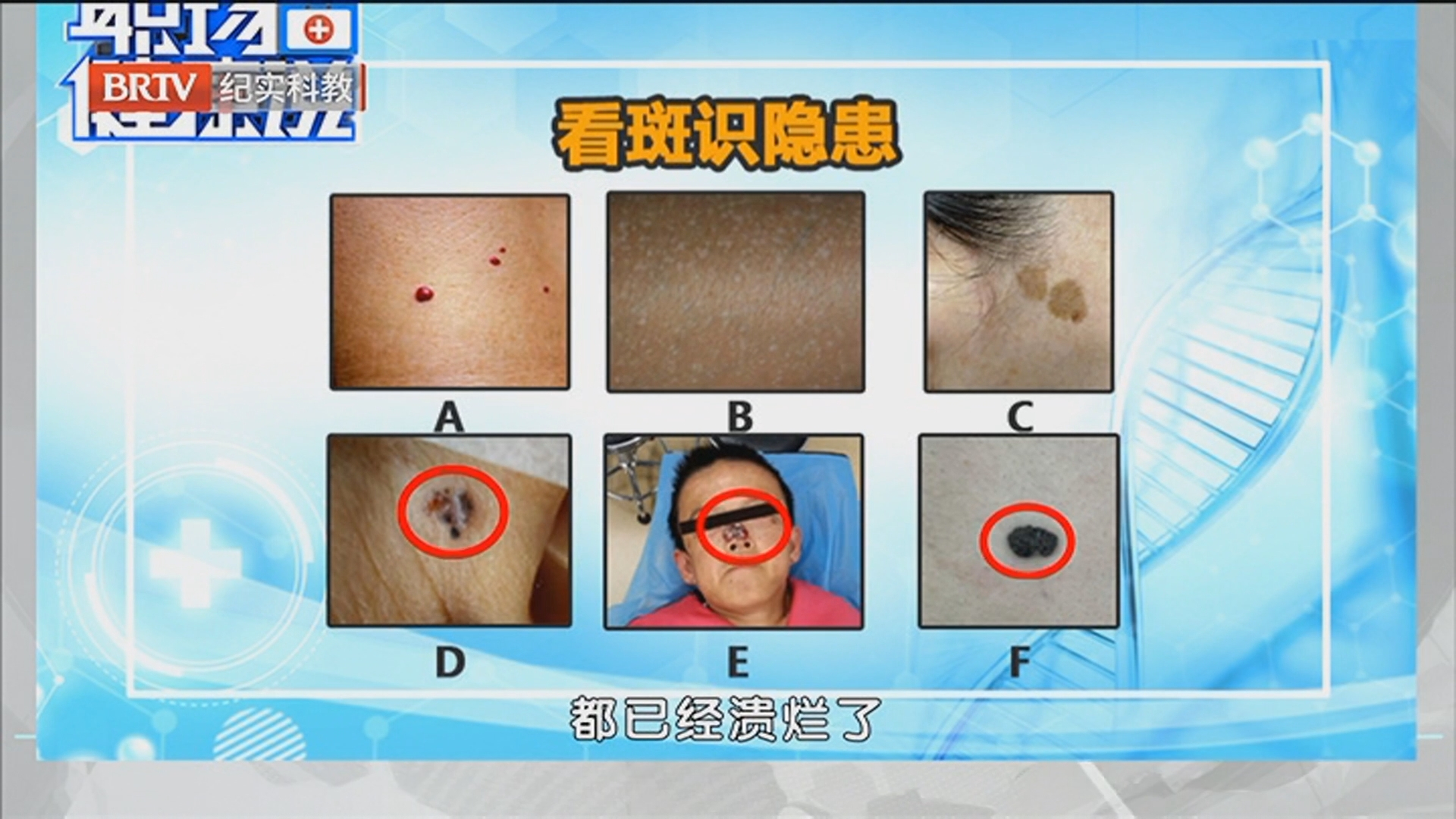 《职场健康说》20260318皮肤上的老年斑有癌变风险吗? 《职场健康说》20260318皮肤上的老年斑有癌变风险吗?