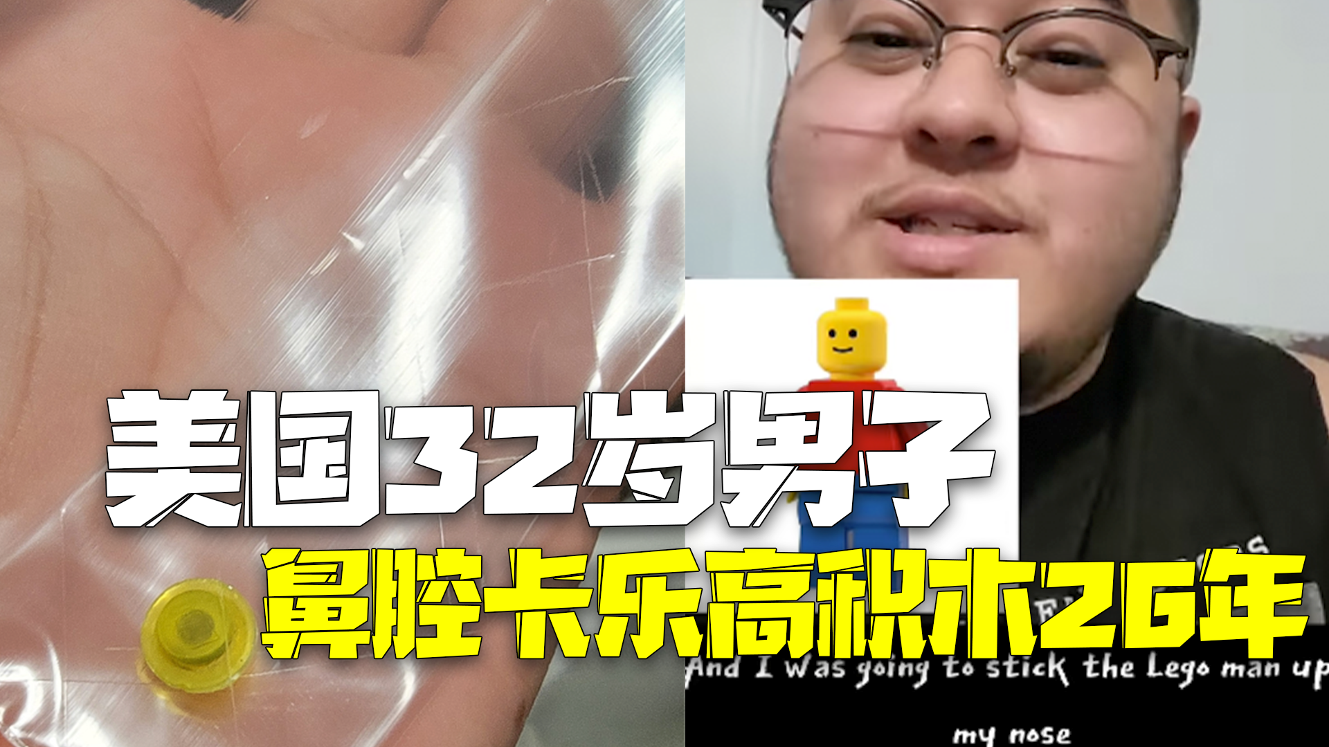 美国32岁男子擤鼻涕喷出乐高积木 已经卡在鼻腔中26年