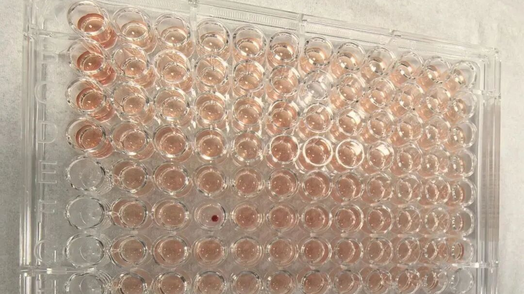 首例!广东顺德发现一例“钻石血”,比“熊猫血”罕见百倍 首例!广东顺德发现一例“钻石血”,比“熊猫血”罕见百倍